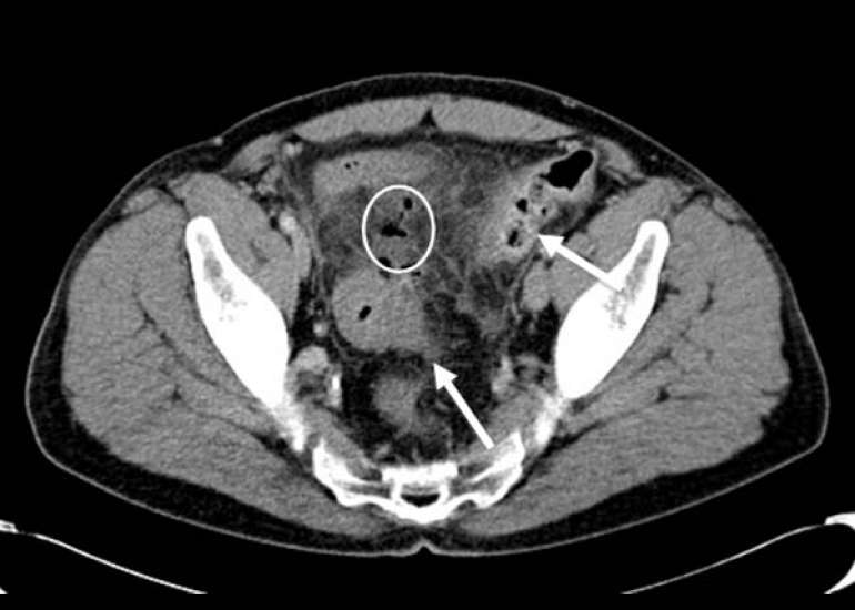 A Case-Report on Diverticulitis Misdiagnosed As Tubo-Ovarian Abscess